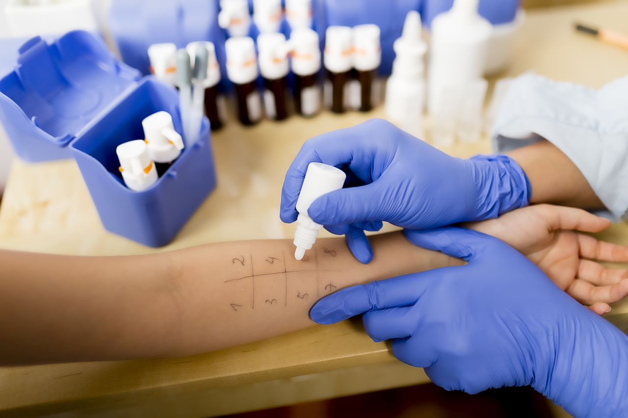 Alergia – na czym polegają testy skórne?
